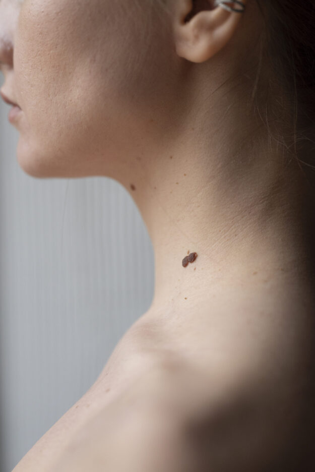melanoma, skin tag, ketuat