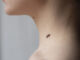melanoma, skin tag, ketuat
