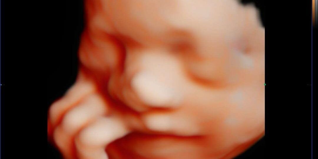 Pregnancy Scan 4D5D Jelas Comel di klinik