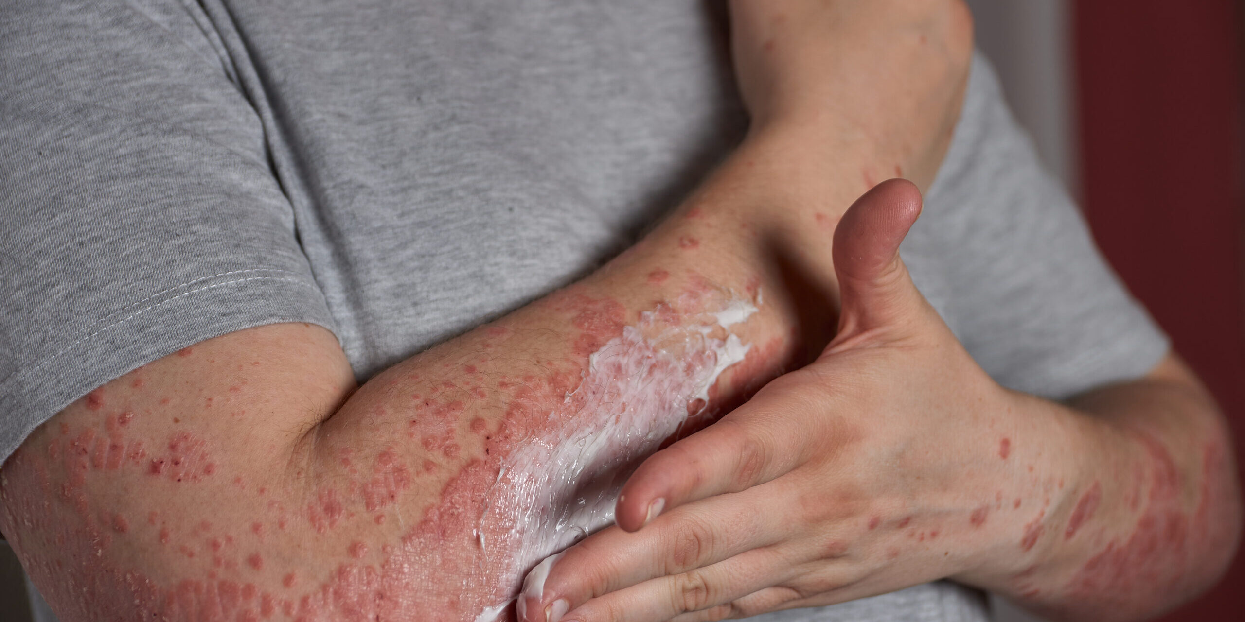 allergy rashed, sesak nafas dan panas badan