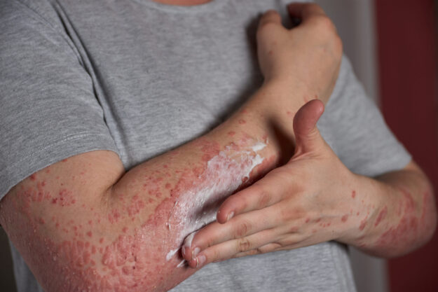 allergy rashed, sesak nafas dan panas badan allergy rashed, sesak nafas dan panas badan