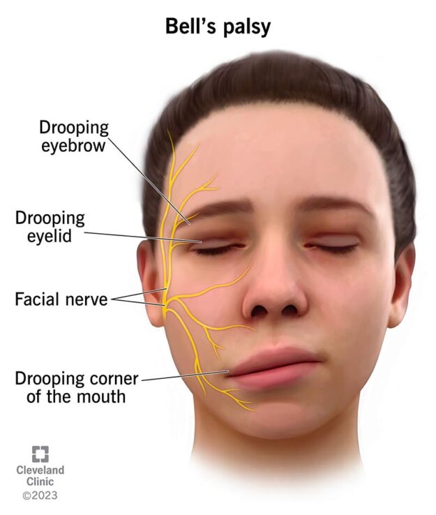 bells-palsy-muka-herot bells-palsy-muka-herot