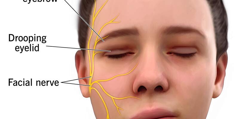bells-palsy-muka-herot
