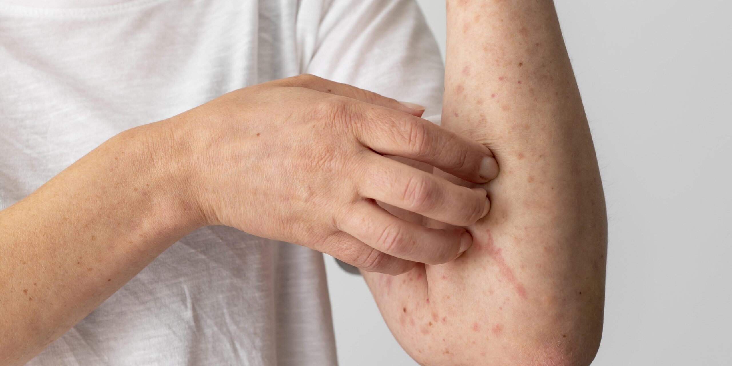skin allergy ruam alahan wet therapy skin allergy ruam alahan wet therapy